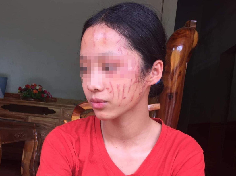 Nữ sinh H. bị bạn cào rách mặt