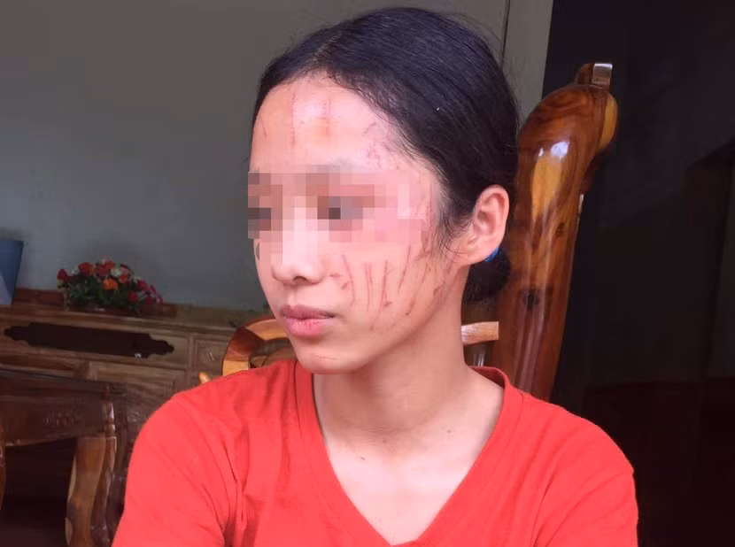 Nữ sinh H. bị bạn cào rách mặt