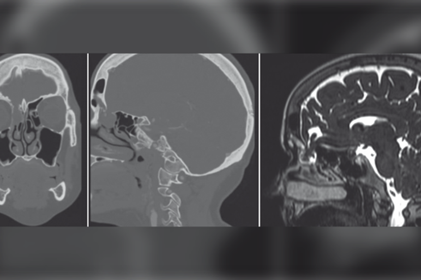 Một bệnh nhân bị rỉ dịch não tủy vì xét nghiệm Covid-19 bằng tăm bông