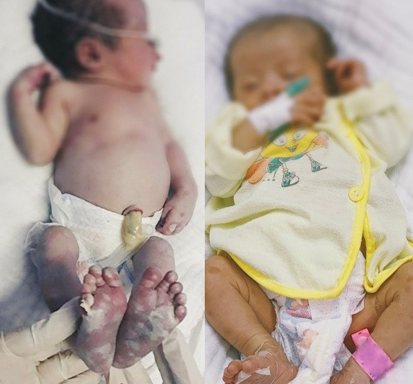 Bệnh nhi trước và sau điều trị (ảnh bệnh viện cung cấp)