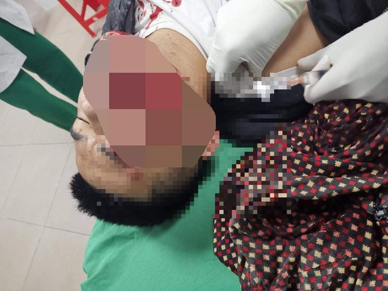 Phần đầu nạn nhân bị thương nặng do pháo nổ