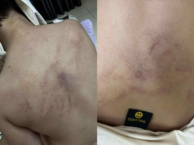 Phụ huynh cháu T.K.L tố giáo viên bạo hành trẻ Phụ huynh cháu T.K.L tố giáo viên bạo hành trẻ