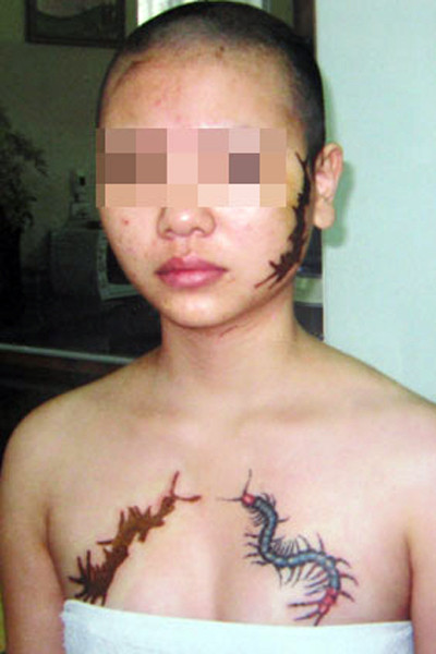 Cô gái bị xăm rết lên ngực được chữa trị miễn phí ảnh 1
