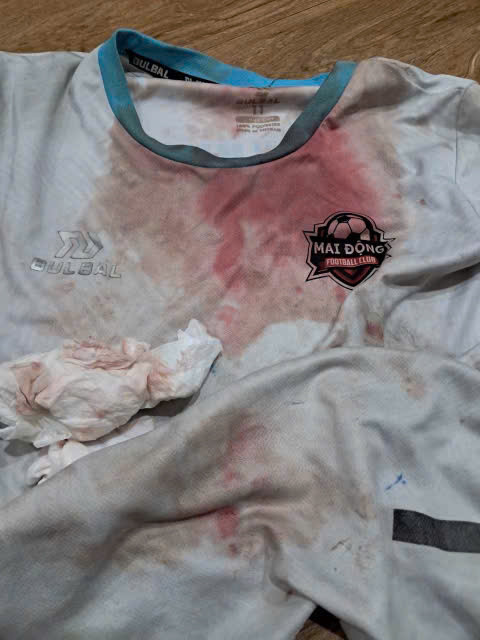 Chiếc áo của cháu M sau khi bị đánh Chiếc áo của cháu M sau khi bị đánh
