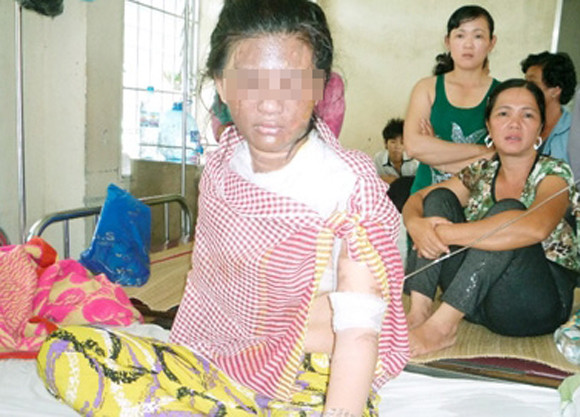 Vợ nằm võng, chồng dội cả nồi nước sôi lên người ảnh 1 Vợ nằm võng, chồng dội cả nồi nước sôi lên người ảnh 1