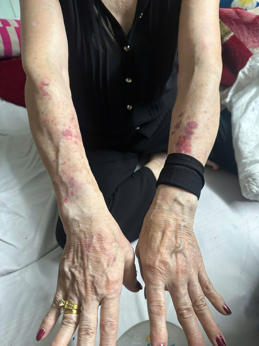 Vết bầm tím của bị hại sau khi bị trói, khống chế Vết bầm tím của bị hại sau khi bị trói, khống chế