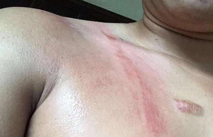 Vết hằn đỏ trên ngực anh P.