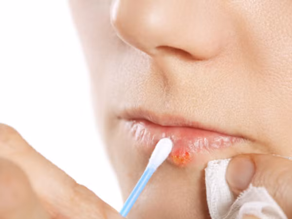Trị những vết mụn lở không mong muốn ảnh 1