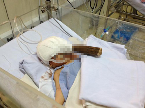 Sự thật vụ bệnh nhi 11 ngày tuổi bị người lạ đâm xuyên sọ ảnh 2