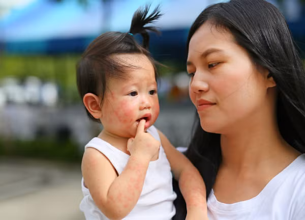 Chìa khóa giải tỏa nỗi lo "Viêm da cơ địa" ảnh 1