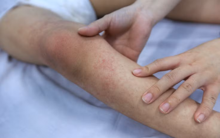 Số mắc SXH ở Hà Nội giảm nhẹ nhưng vẫn ở mức cao