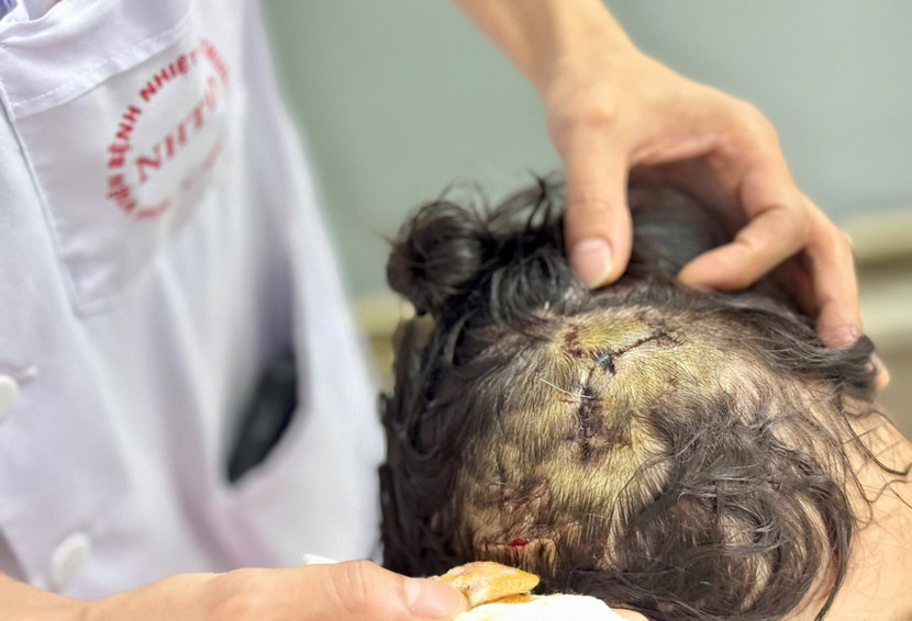 Cháu bé được các bác sĩ xử lý vết thương phần đầu do chó cắn (Ảnh: BVCC) Cháu bé được các bác sĩ xử lý vết thương phần đầu do chó cắn (Ảnh: BVCC)
