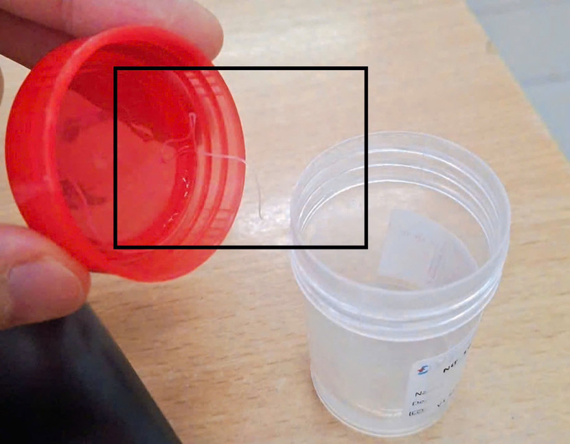 Ký sinh trùng được lấy ra khỏi mắt bệnh nhân (Ảnh: BVCC)