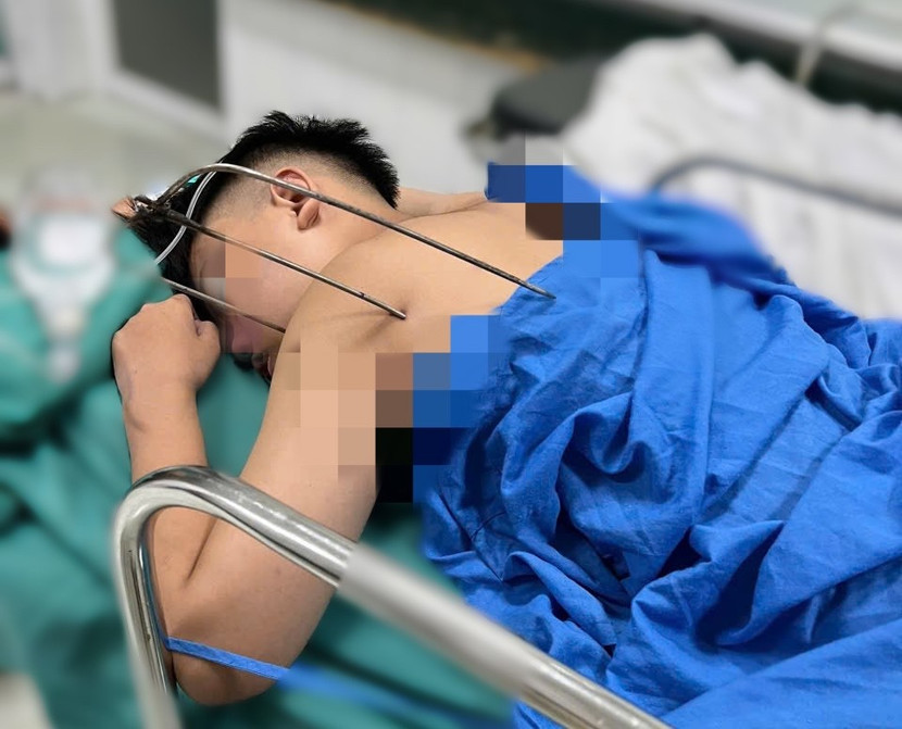 Nam thanh niên nhập viện với cây kim loại cắm sâu trong cơ thể Nam thanh niên nhập viện với cây kim loại cắm sâu trong cơ thể