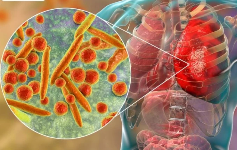 Một số trường hợp bệnh đã xác định nguyên nhân là do nhiễm vi khuẩn Mycoplasma