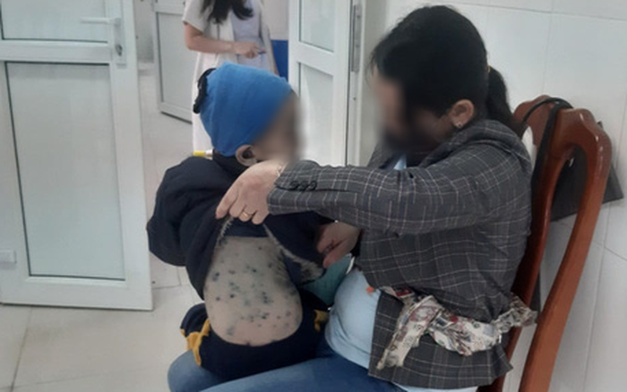 Mỗi tuần Hà Nội đang ghi nhận trung bình 70-100 ca mắc thủy đậu (Ảnh minh họa)