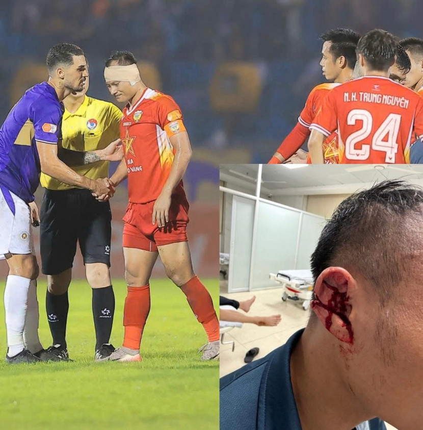 Hình ảnh Trọng Hoàng bị rách hai vết dài ở tai vẫn "chiến" tới hết trận khiến khán giả cảm phục