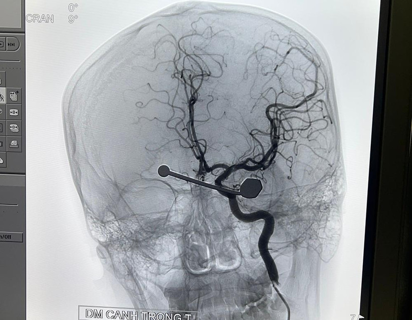 Hình ảnh chiếu chụp cho thấy thanh dị vật cắm sâu vào mắt trái bệnh nhân Hình ảnh chiếu chụp cho thấy thanh dị vật cắm sâu vào mắt trái bệnh nhân