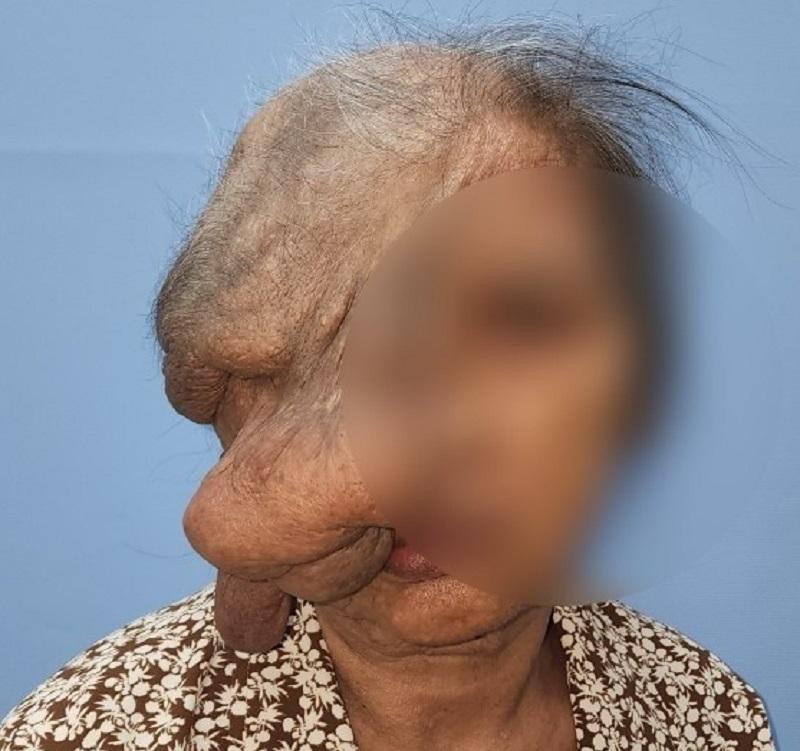 Bệnh nhân nhập viện với khối u dị dạng che kín mặt Bệnh nhân nhập viện với khối u dị dạng che kín mặt