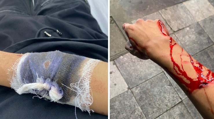 Cháu T.L.T.M. Bị chém gây thương tích nặng