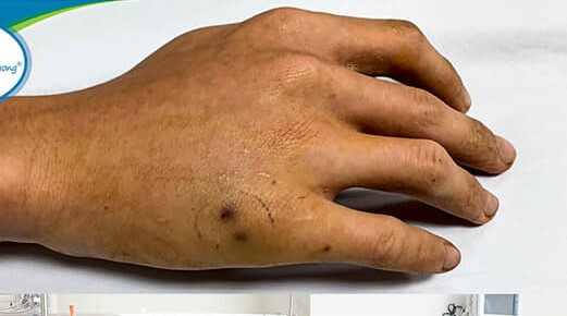 Bệnh nhi vào cấp cứu với vết răng rắn lục cắn ở bàn tay Bệnh nhi vào cấp cứu với vết răng rắn lục cắn ở bàn tay