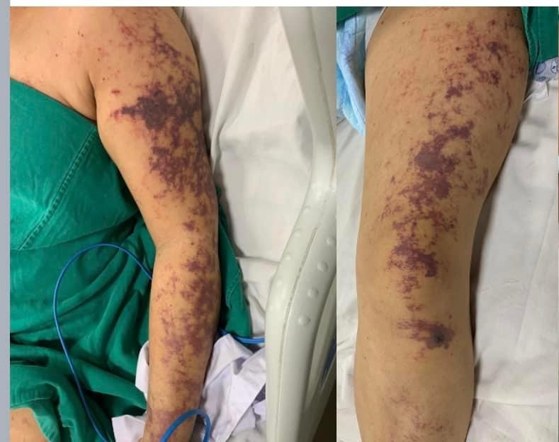Bệnh nhân nhập viện với các mảng da tím đen
