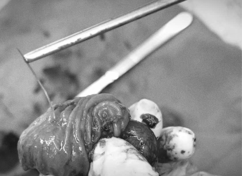 Các bác sĩ gắp ra chiếc xương cá dài 4cm đâm thủng ruột non người bệnh