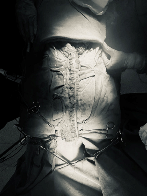 Đoạn đại tràng được đưa lên để tạo hình thực quản