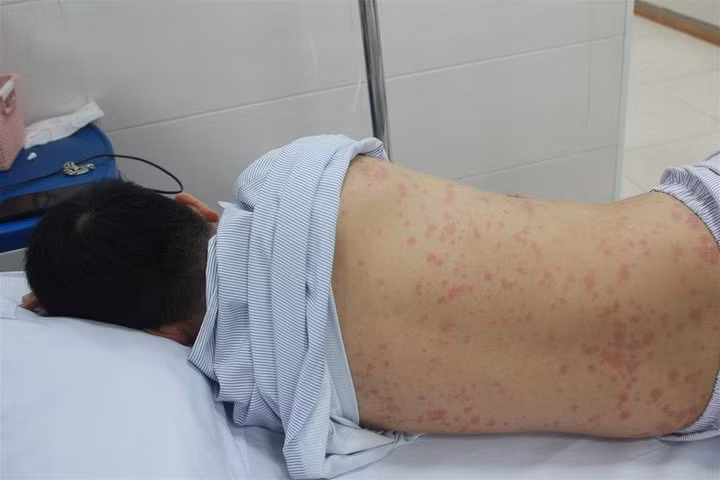 Hà Nội tiếp tục ghi nhận ca mắc liên cầu khuẩn lợn (Ảnh minh họa)