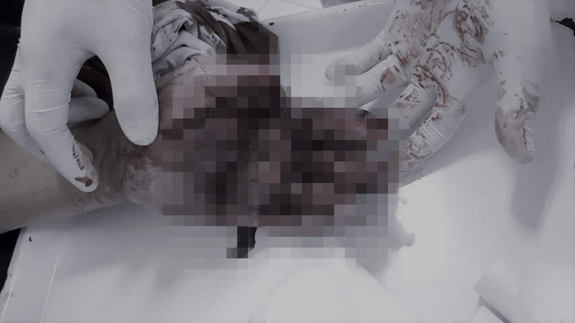 Bàn tay bệnh nhân bị dập nát, cụt 2 ngón tay