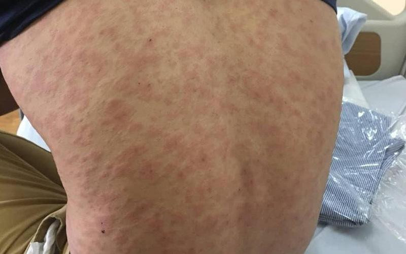 Một trường hợp bị dị ứng do ăn hải sản (Ảnh minh họa) Một trường hợp bị dị ứng do ăn hải sản (Ảnh minh họa)