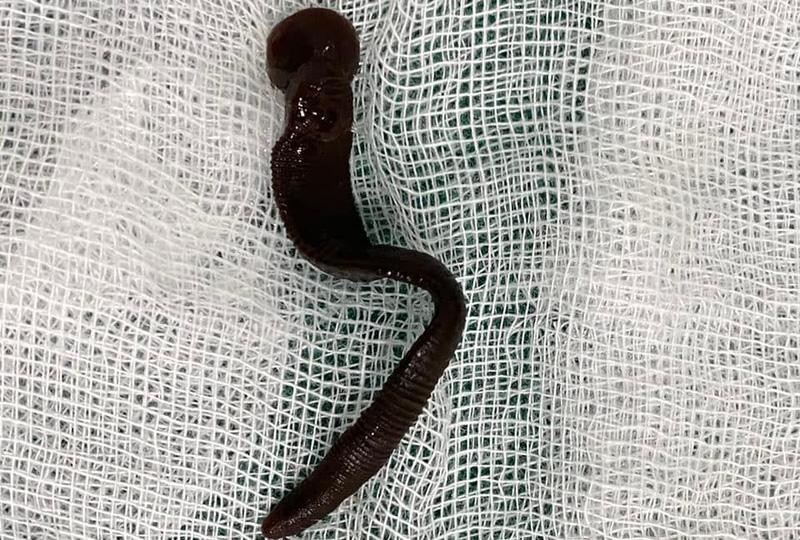 Dị vật là con đỉa lớn, còn sống được gắp ra ngoài (Ảnh: BVCC) Dị vật là con đỉa lớn, còn sống được gắp ra ngoài (Ảnh: BVCC)