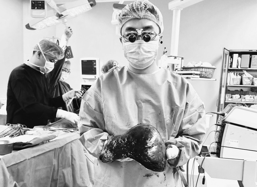 Khối u máu gan khổng lồ được các bác sĩ lấy ra thành công cho bệnh nhân