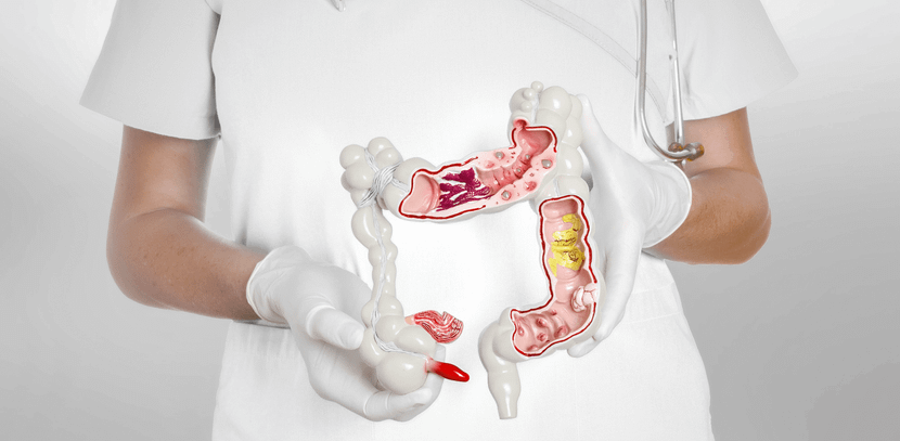 Các bệnh lý tiêu hóa không được điều trị đúng cách rất dễ dẫn đến ung thư