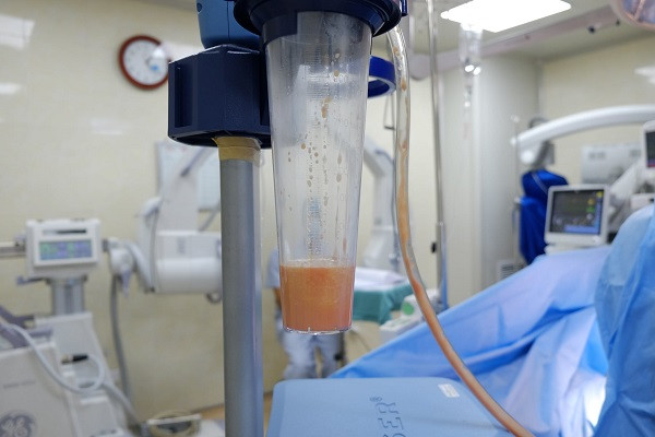 Các bác sĩ Bệnh viện E sử dụng phương pháp mới để hút mỡ vùng bụng, đùi cho cô gái trẻ