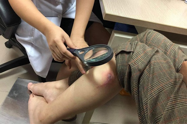 Bác sĩ BV Da liễu Trung ương khám cho một bệnh nhân bị kiến ba khoang đốt