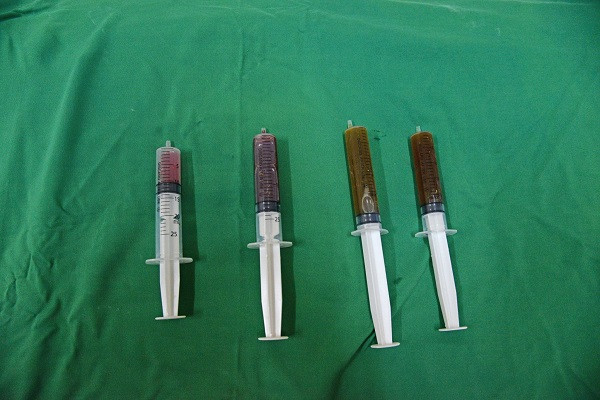 Bơm cồn tuyệt đối để điều trị nang giáp là phương pháp rất mới