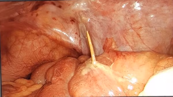 Hình ảnh nội soi ổ bụng của bệnh nhân phát hiện que tăm đâm thủng ruột non
