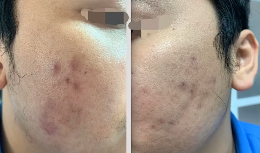 Sau hơn nửa năm điều trị tại BV Da liễu Trung ương, gương mặt nam bệnh nhân vẫn sần sùi Sau hơn nửa năm điều trị tại BV Da liễu Trung ương, gương mặt nam bệnh nhân vẫn sần sùi