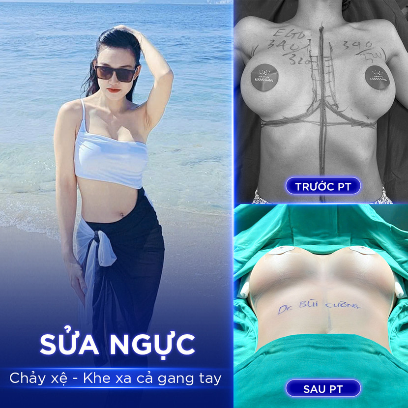 Kết quả sửa ngực chảy xệ - khe xa cả gang tay của chị Bảo Uyên