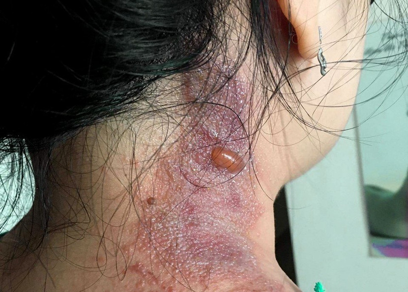 Nhiều trường hợp bị viêm da tiếp xúc do kiến ba khoang (Ảnh minh họa) Nhiều trường hợp bị viêm da tiếp xúc do kiến ba khoang (Ảnh minh họa)