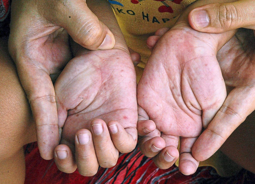 Số ca mắc tay chân miệng tại Hà Nội đang gia tăng nhanh (Ảnh minh họa)