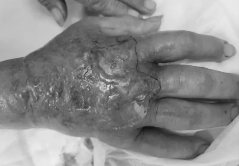 Bàn tay hoại tử của một bệnh nhân bị rắn độc cắn đang điều trị tại Bệnh viện Bạch Mai