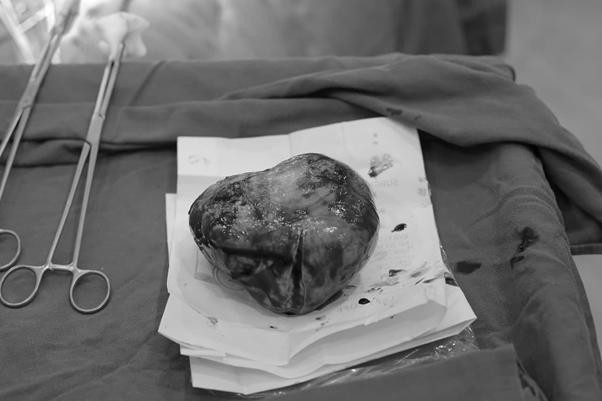 Khối u "khủng" được mổ bóc tách lấy ra, kết hợp cùng ca mổ lấy thai