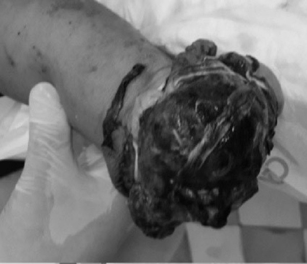 Bàn tay phải của bệnh nhân bị cụt hoàn toàn