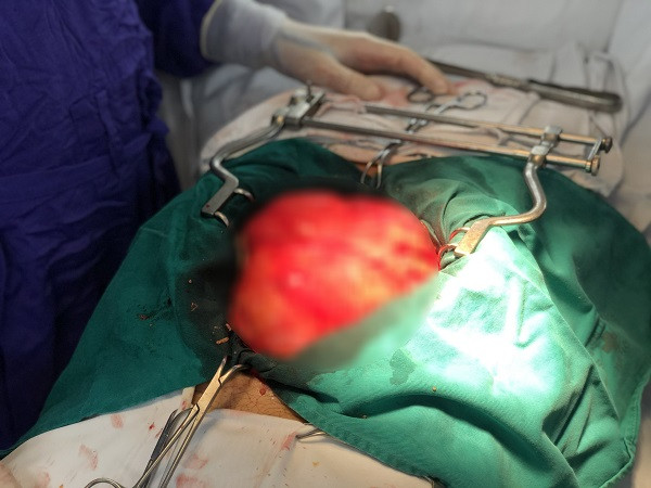 Khối u khổng lồ choán hết ổ bụng, đẩy lệch thành bụng trái Khối u khổng lồ choán hết ổ bụng, đẩy lệch thành bụng trái