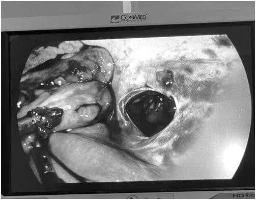 Hình ảnh chụp chiếu cho thấy vết thương do dao đâm rộng khoảng 3cm đang chảy máu