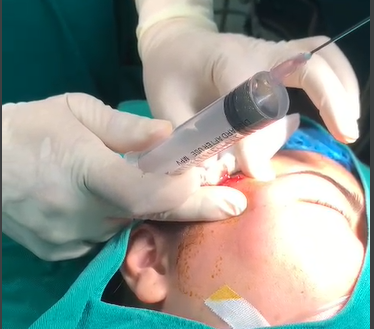 Nhiều trường hợp gặp biến chứng mù mặt sau tiêm filler ở các cơ sở không phép Nhiều trường hợp gặp biến chứng mù mặt sau tiêm filler ở các cơ sở không phép