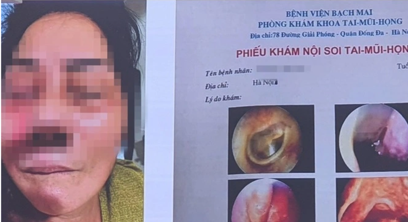 Hình ảnh chiếu chụp của một nữ bệnh nhân bị hoại tử xương hàm mặt do nhiễm nấm đen điều trị tại BV Bạch Mai