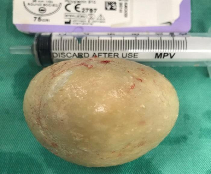 Khối sỏi thận khổng lồ được lấy ra từ người đàn ông 61 tuổi